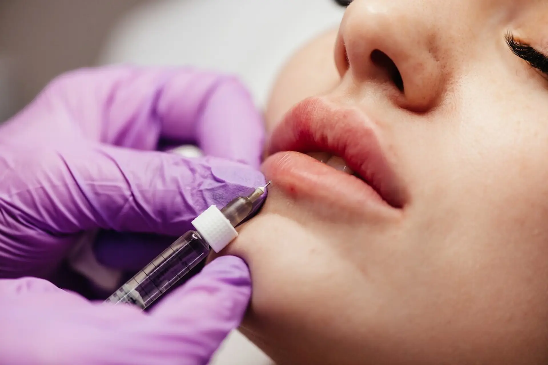 Lip Fillers Near Me: Your Complete Guide to Fuller, Natural-Looking Lips